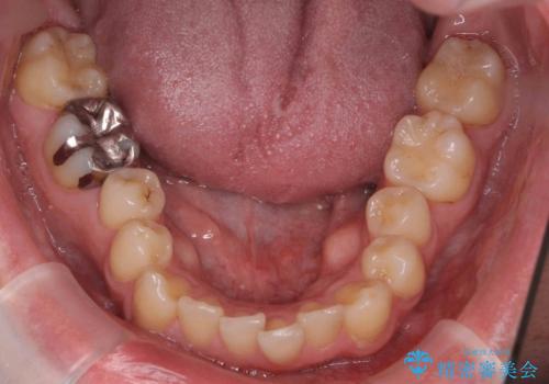 出っ歯と歯のねじれ　非抜歯で　30代男性の治療前