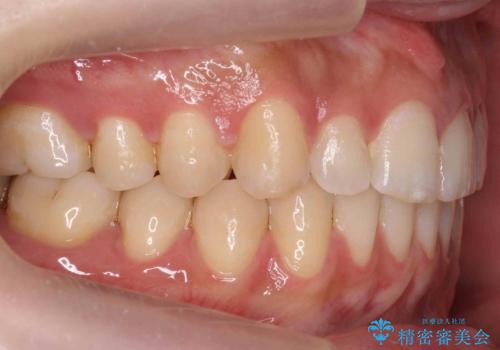 すきっ歯 セラミックで治すか矯正で治すか相談したいの治療後