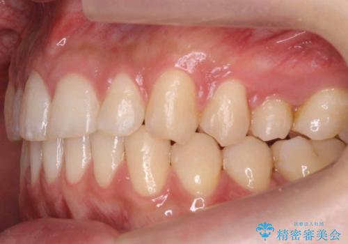 すきっ歯 セラミックで治すか矯正で治すか相談したいの治療後