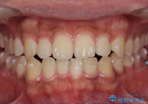 骨格性の受け口　非抜歯で下の歯を後ろに下げる　インビザラインで　インプラント矯正の治療中