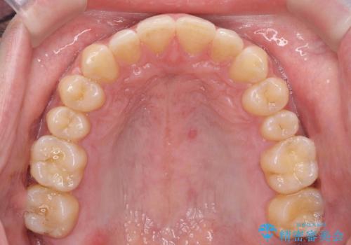 すきっ歯 セラミックで治すか矯正で治すか相談したいの治療後