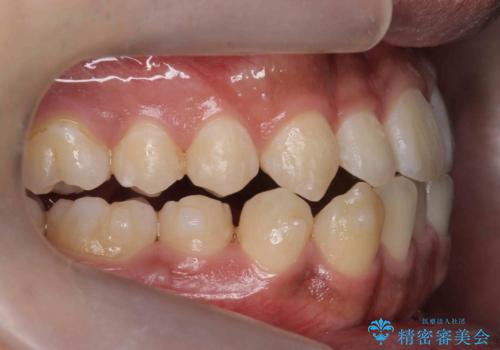 骨格性の受け口 非抜歯で下の歯を後ろに下げる インビザラインで インプラント矯正の治療中