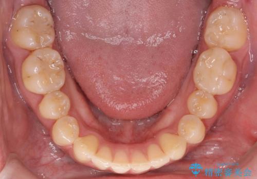 すきっ歯 セラミックで治すか矯正で治すか相談したいの治療後