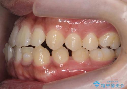 骨格性の受け口 非抜歯で下の歯を後ろに下げる インビザラインで インプラント矯正の治療中