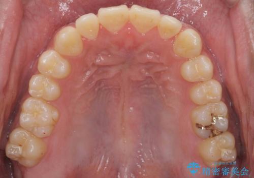 骨格性の受け口　非抜歯で下の歯を後ろに下げる　インビザラインで　インプラント矯正の治療中