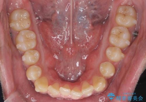 骨格性の受け口 非抜歯で下の歯を後ろに下げる インビザラインで インプラント矯正の治療中