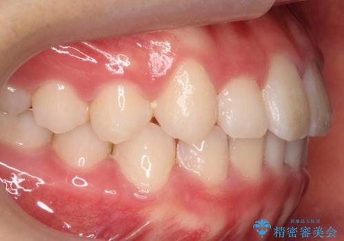 八重歯 歯を抜かずにインビザラインでの治療中