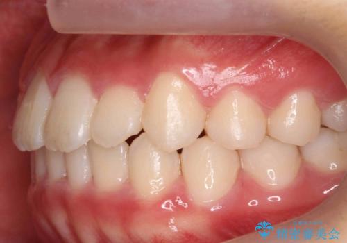 八重歯 歯を抜かずにインビザラインでの治療中