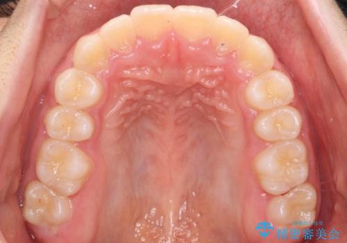 八重歯 歯を抜かずにインビザラインでの治療後