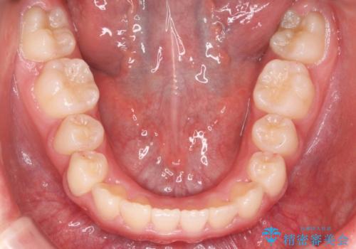 八重歯 歯を抜かずにインビザラインでの治療後