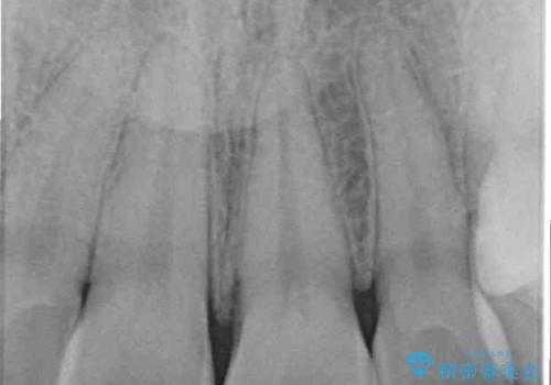 変色した前歯の詰め物 オールセラミッククラウンで本物の前歯のようにの治療前