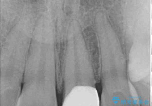 変色した前歯の詰め物 オールセラミッククラウンで本物の前歯のようにの治療後