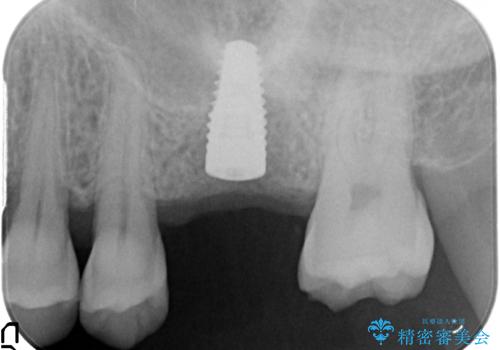 失った咬合機能の回復 インプラント治療の治療中