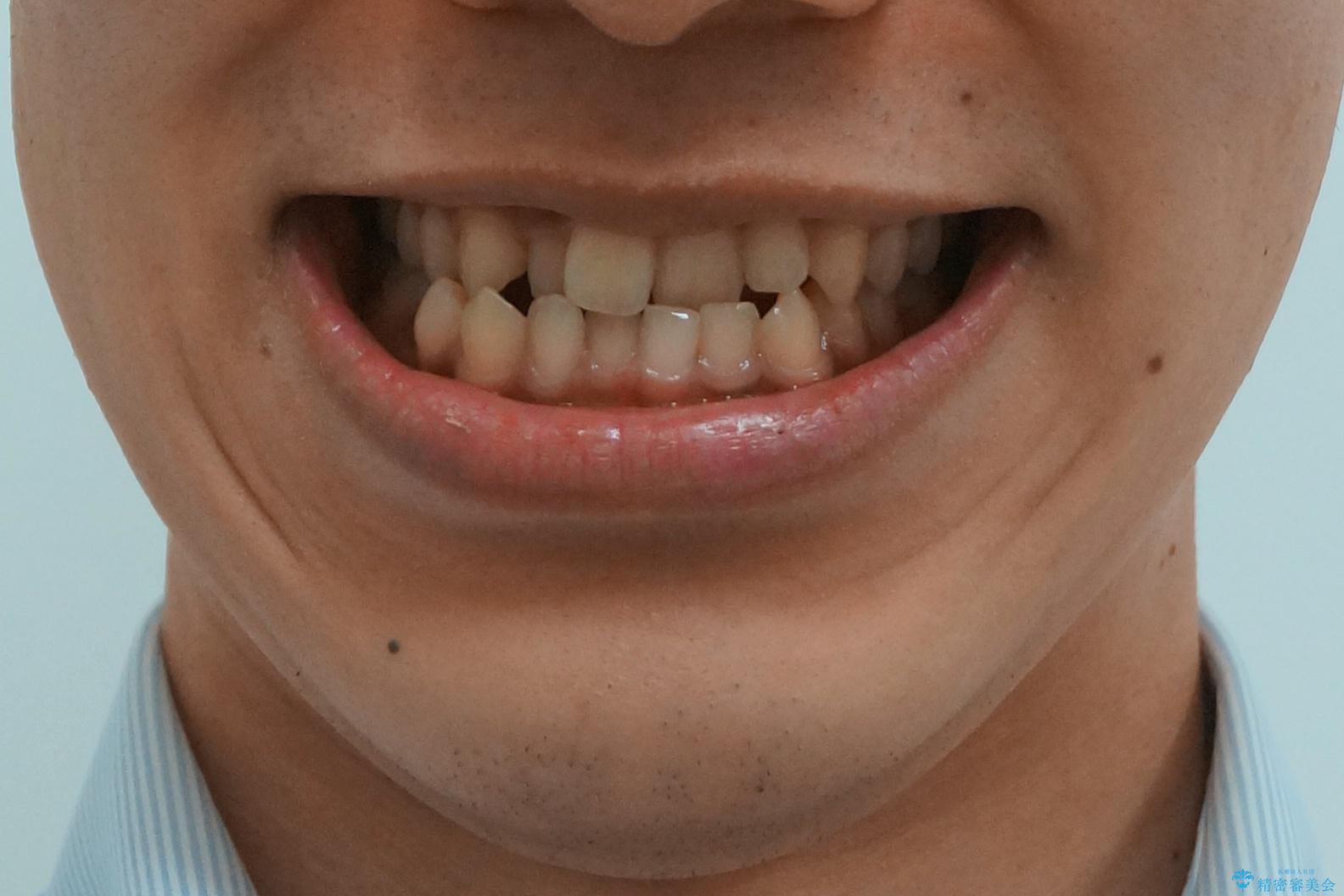 骨格性の受け口 非抜歯で下の歯を後ろに下げる インビザラインで インプラント矯正の治療前(顔貌)