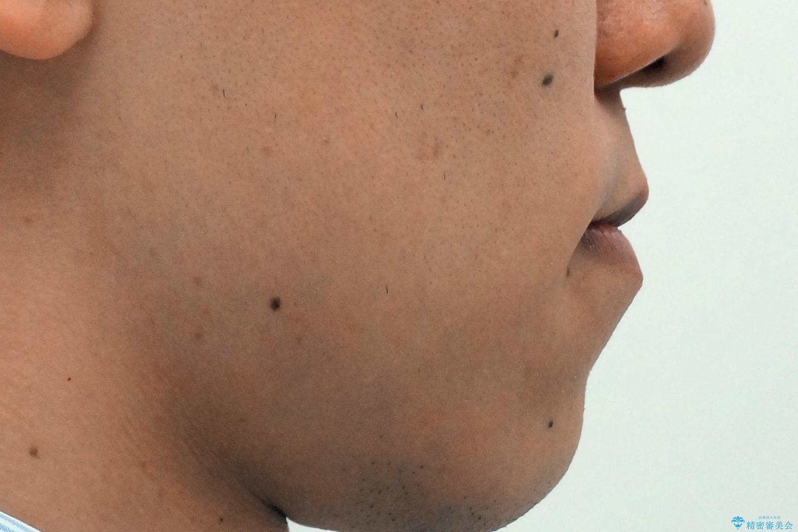 骨格性の受け口 非抜歯で下の歯を後ろに下げる インビザラインで インプラント矯正の治療前(顔貌)