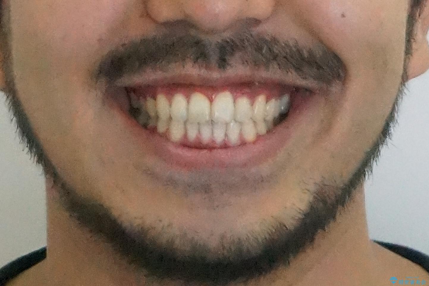 前歯が反対にかんでいる 部分ワイヤーとインビザラインの併用で短期治療の治療後(顔貌)