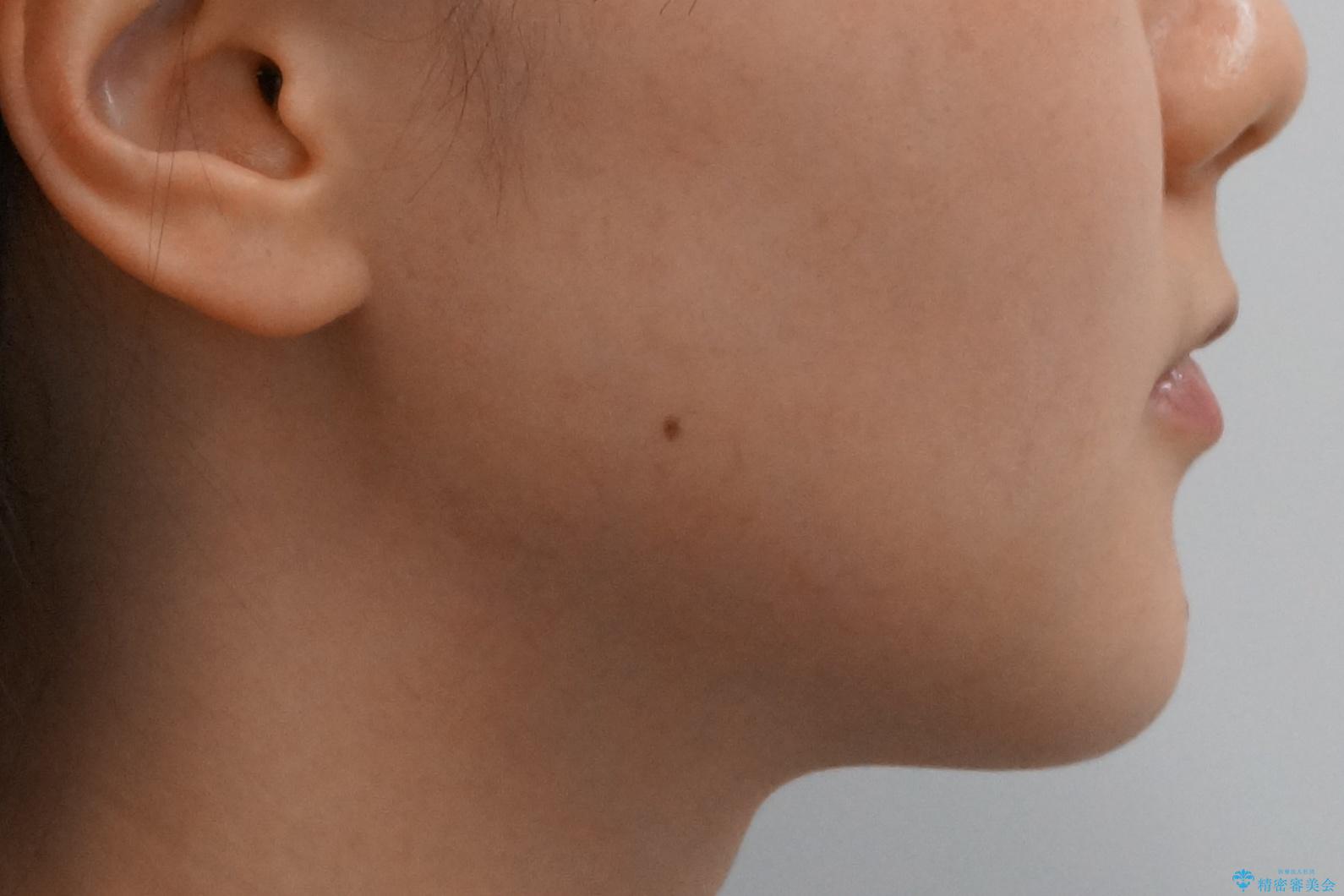 八重歯 インビザラインで抜歯矯正 ただし1本のみの抜歯で済みますの治療前(顔貌)