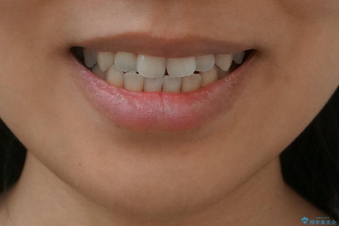 前歯のがたつき 若干受け口 インビザラインでの治療前(顔貌)