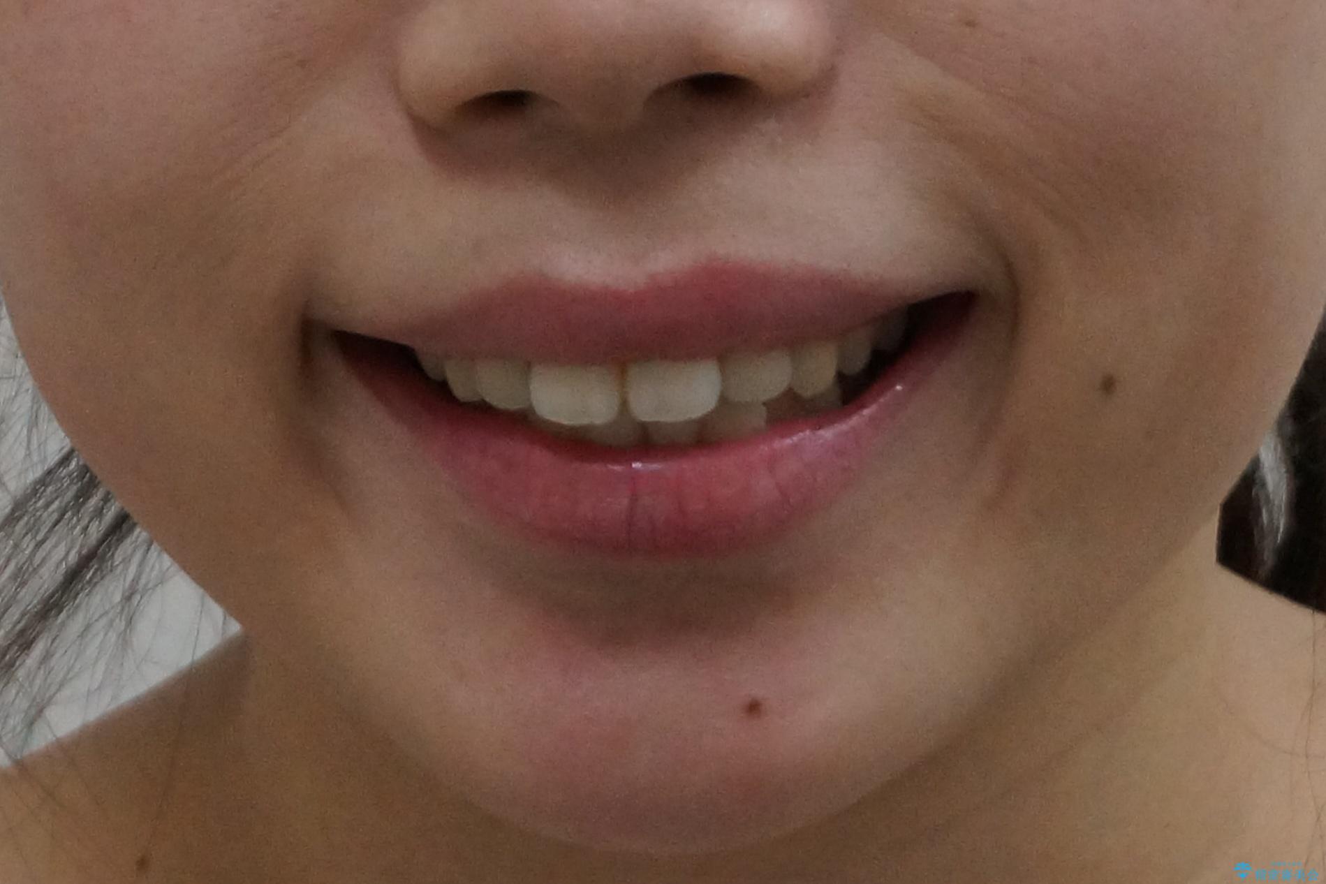 前歯の並び モニター治療での治療前(顔貌)