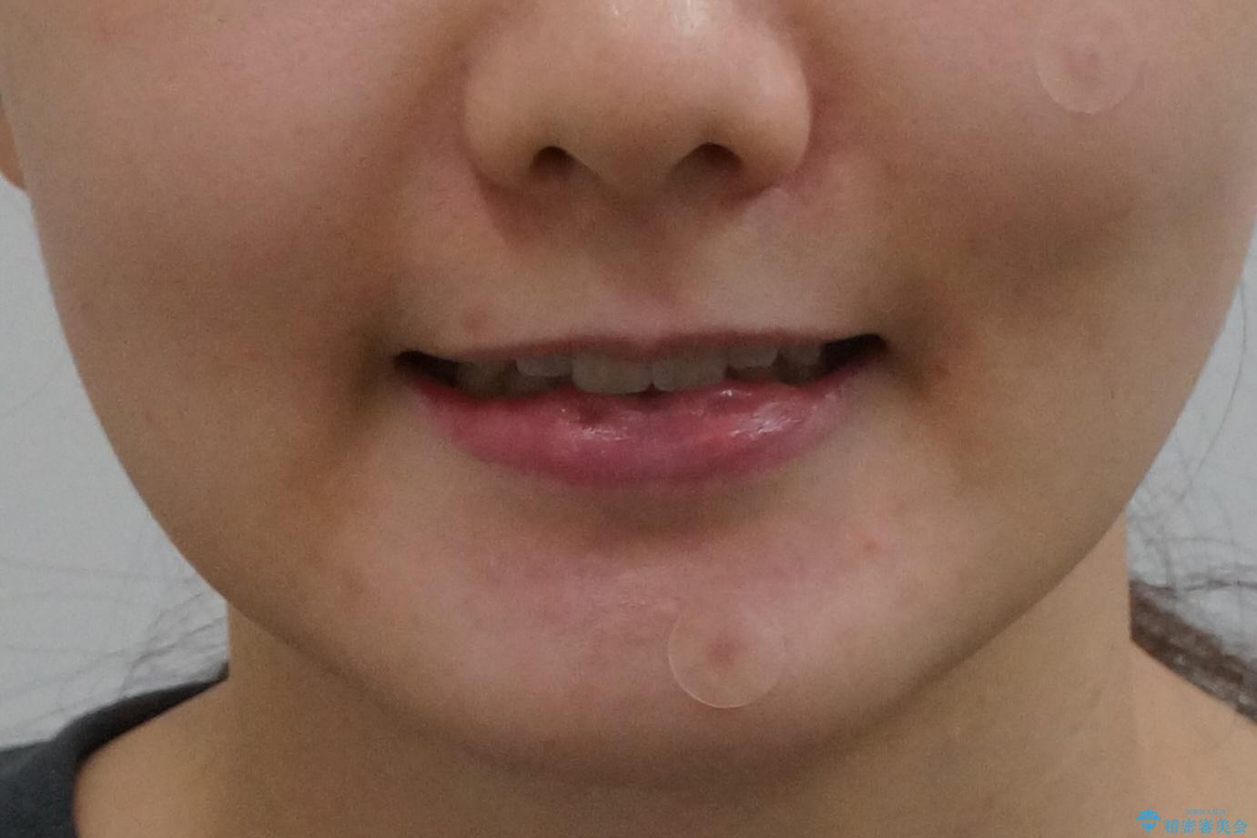 八重歯 インビザラインで抜歯矯正 ただし1本のみの抜歯で済みますの治療後(顔貌)