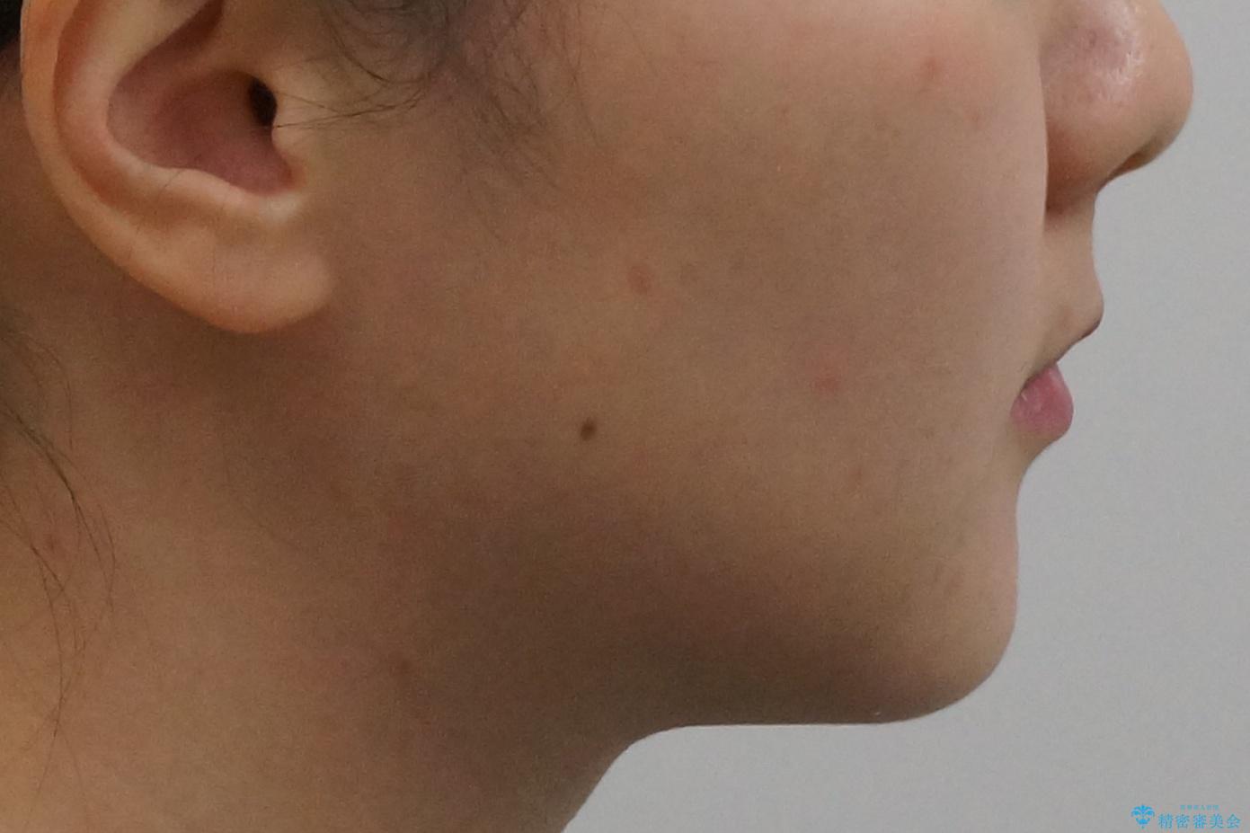 八重歯 インビザラインで抜歯矯正 ただし1本のみの抜歯で済みますの治療後(顔貌)