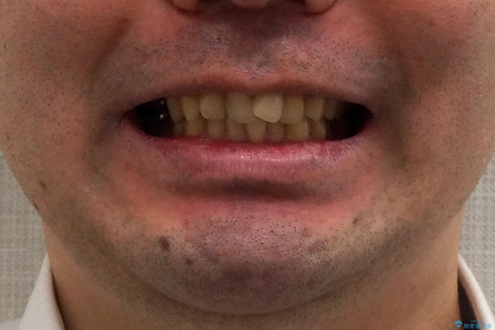 出っ歯と歯のねじれ 非抜歯で 30代男性の治療前(顔貌)