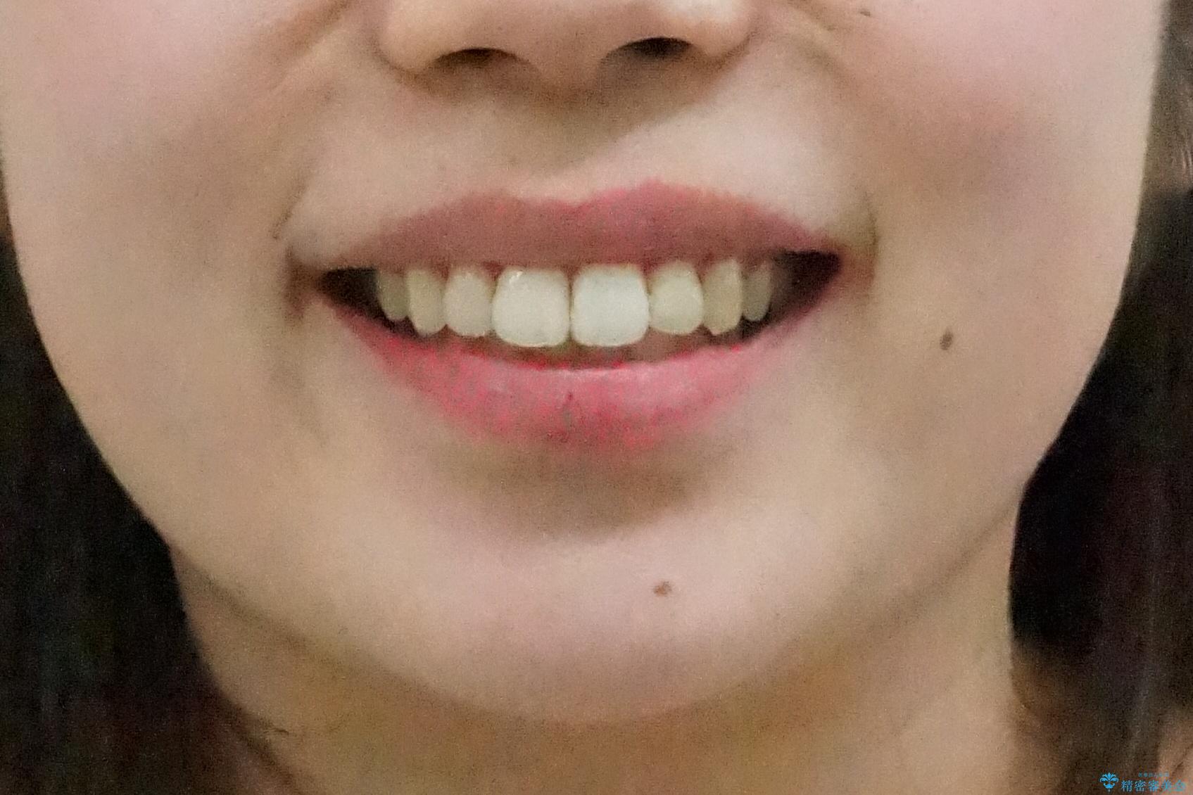 前歯の並び モニター治療での治療後(顔貌)