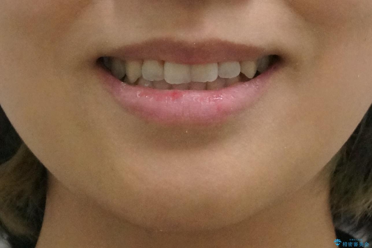 前歯のがたつき 若干受け口 インビザラインでの治療後(顔貌)