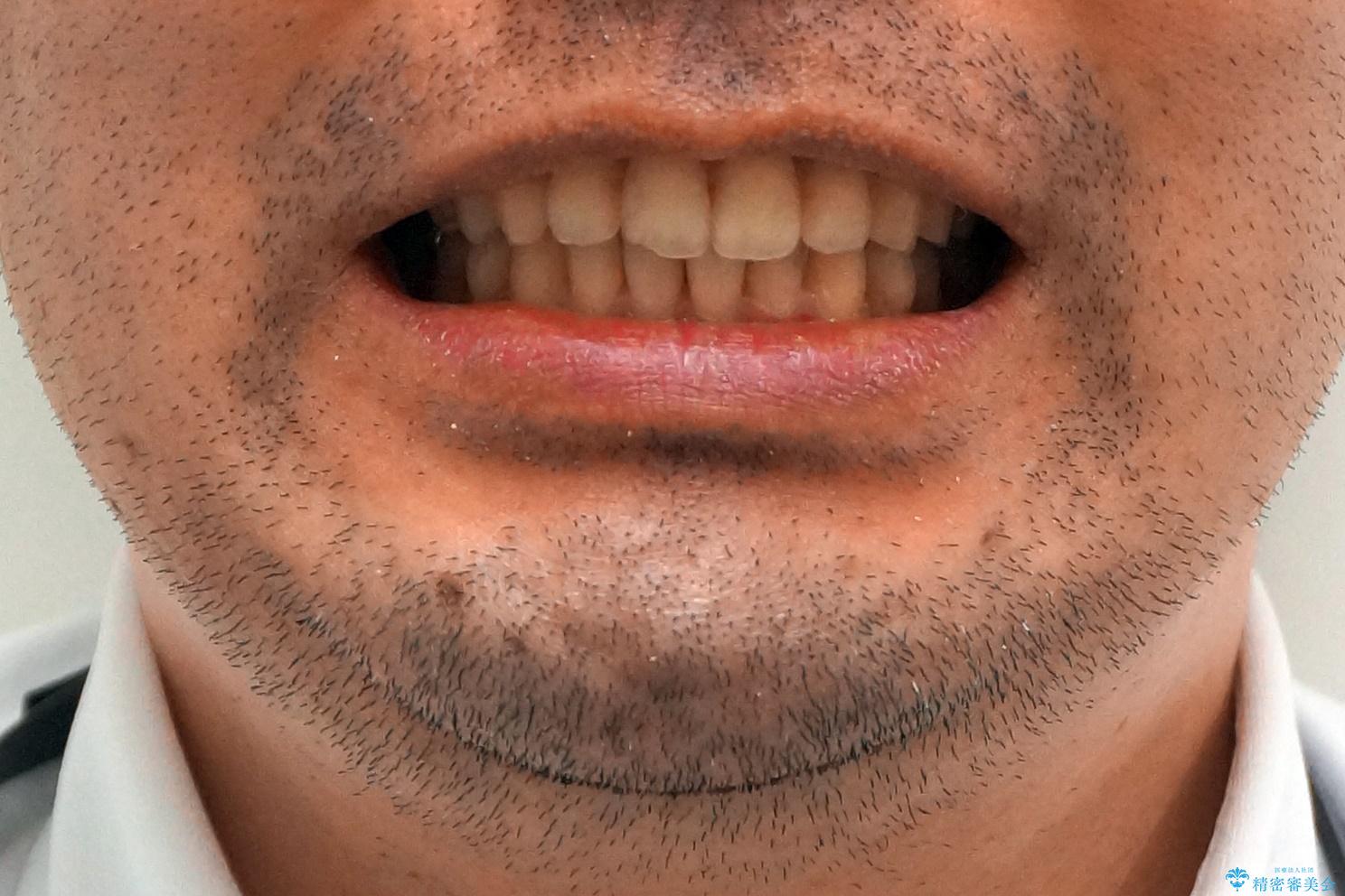 出っ歯と歯のねじれ 非抜歯で 30代男性の治療後(顔貌)