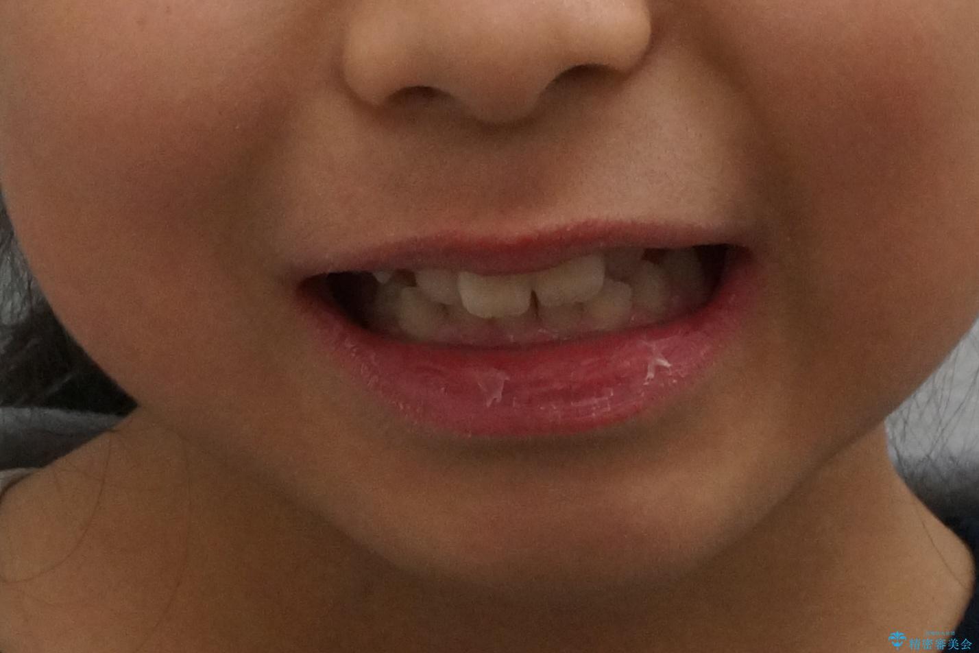 八重歯 歯を抜かずにインビザラインでの治療前(顔貌)