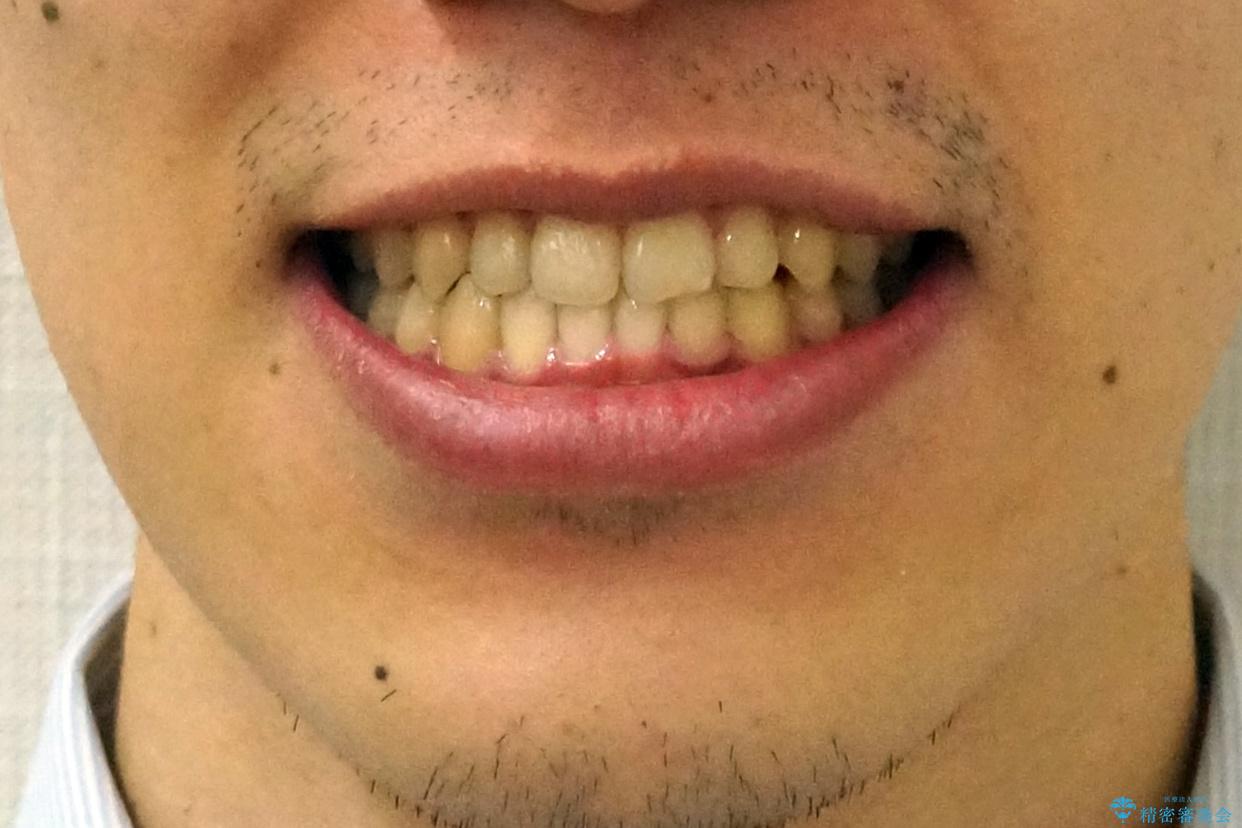 骨格性の受け口 非抜歯で下の歯を後ろに下げる インビザラインで インプラント矯正の治療後(顔貌)