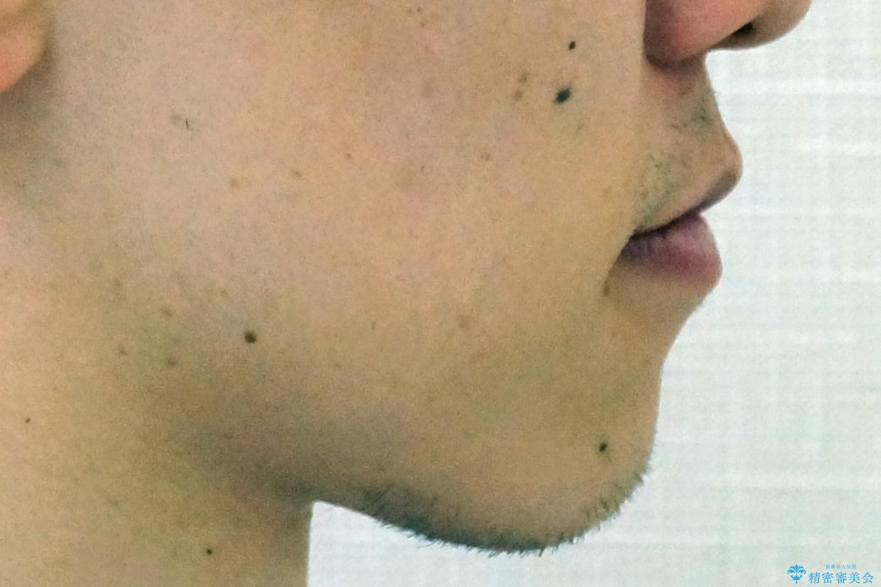 骨格性の受け口 非抜歯で下の歯を後ろに下げる インビザラインで インプラント矯正の治療後(顔貌)