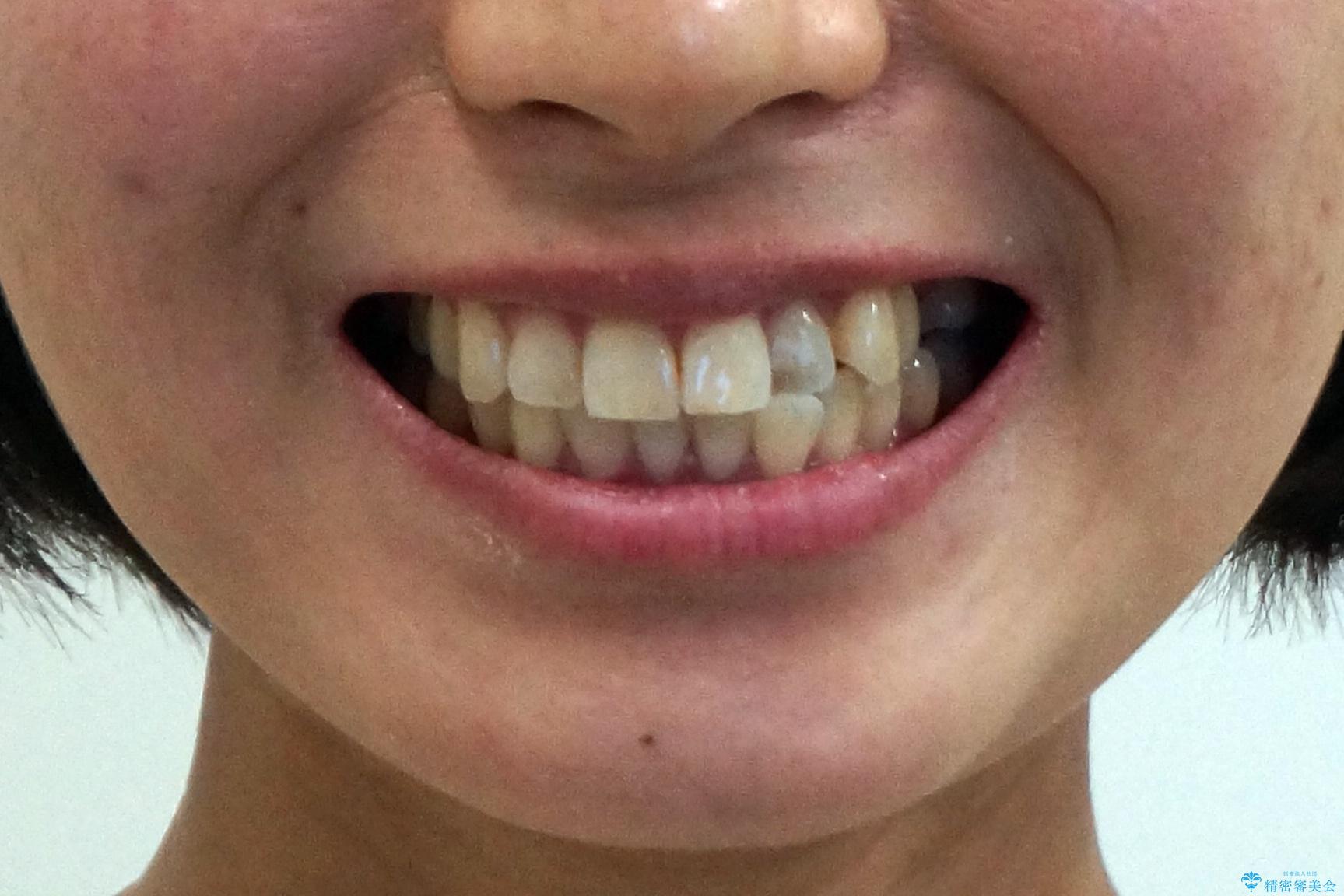 前歯と奥歯の反対咬合 部分ワイヤーとインビザラインでの治療前(顔貌)