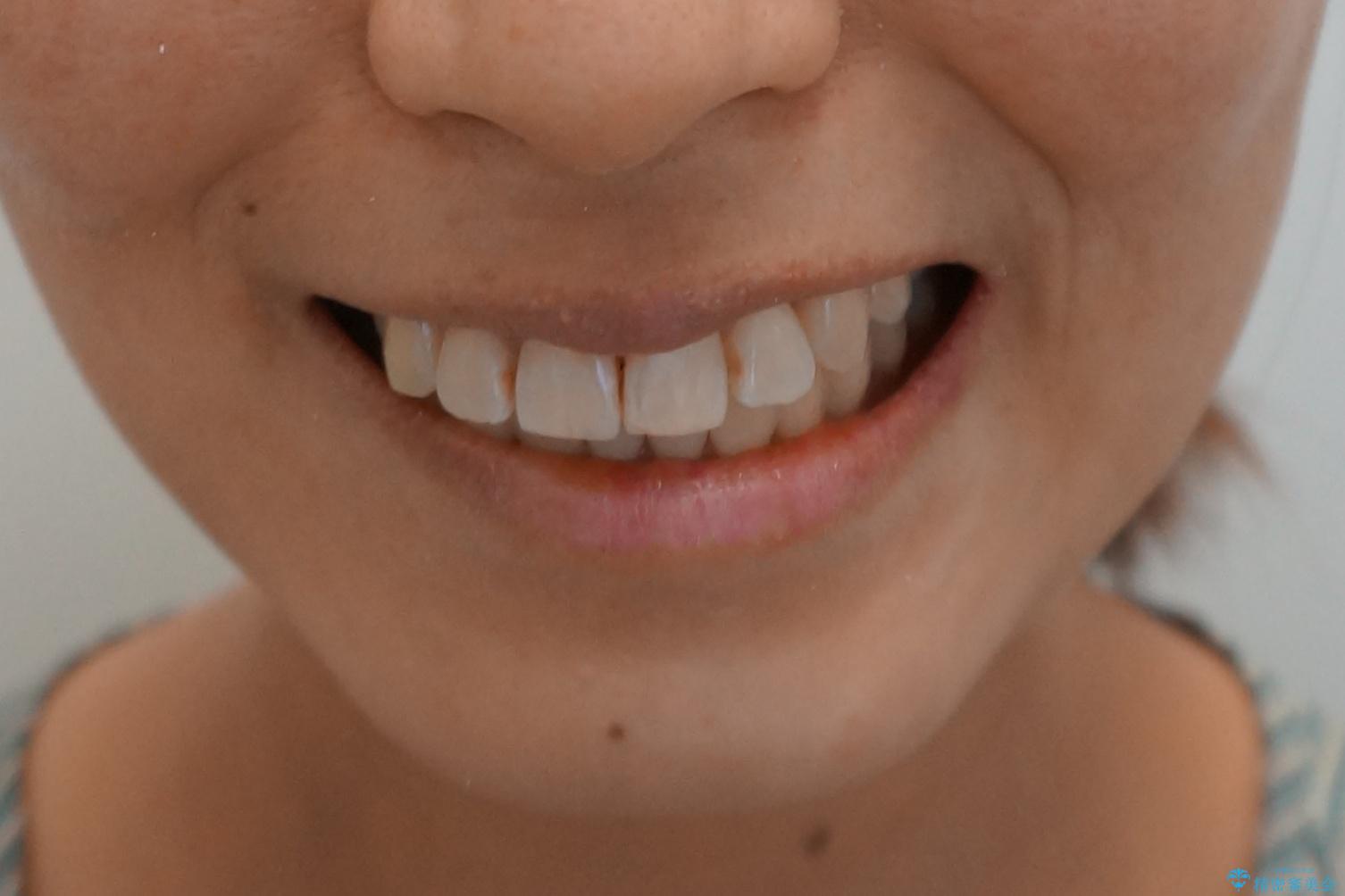 前歯と奥歯の反対咬合 部分ワイヤーとインビザラインでの治療後(顔貌)