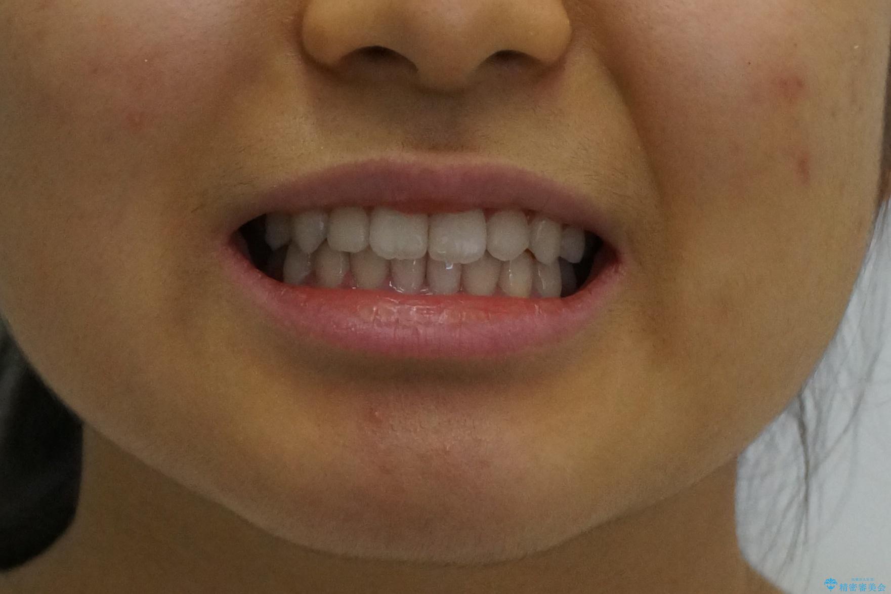 八重歯 歯を抜かずにインビザラインでの治療後(顔貌)