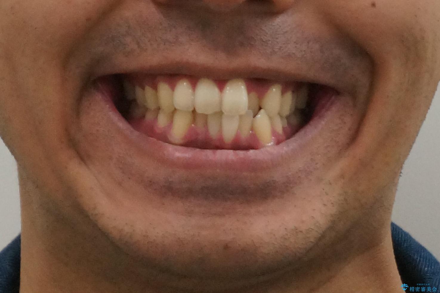 前歯が反対にかんでいる 部分ワイヤーとインビザラインの併用で短期治療の治療前(顔貌)