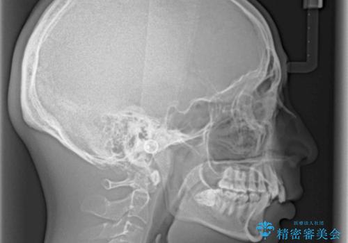 八重歯の抜歯矯正 インビザラインを用いて気になる歯並びを改善の治療前