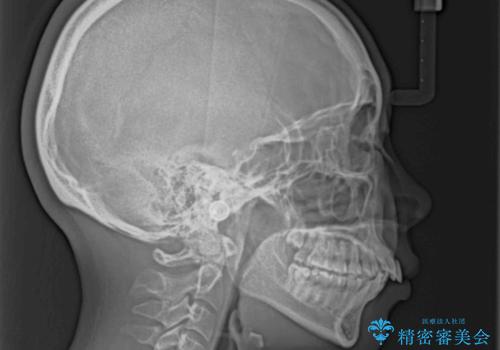 上顎前突で口が閉じにくい ワイヤー装置での抜歯矯正の治療前