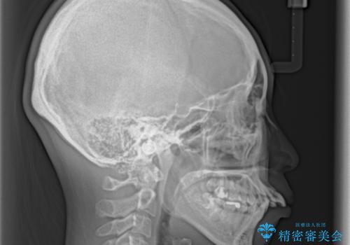 出っ歯を治したい ワイヤー装置での抜歯矯正で劇的変化!の治療前