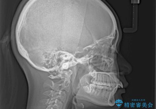 前に飛び出した上顎前歯をスッキリと引っ込める ワイヤー装置での矯正治療の治療前