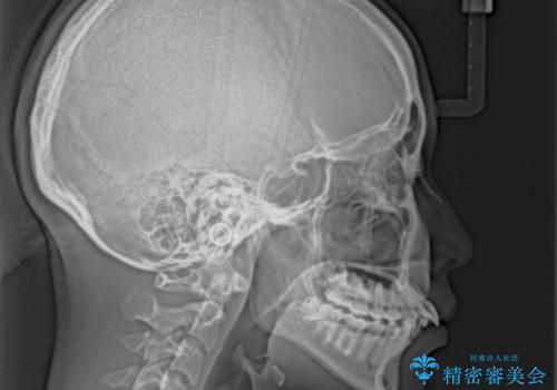 指が入るくらいに隙間のある上下前歯 抜歯矯正で横顔の印象が大きく改善の治療前