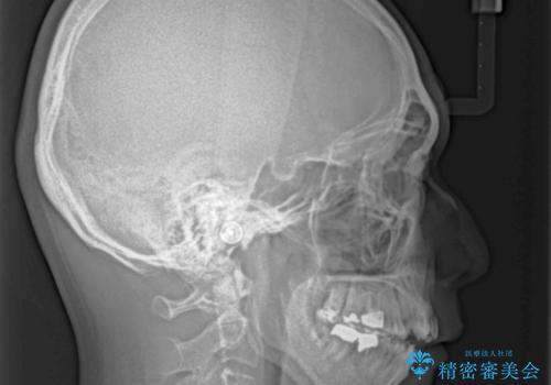 外科手術を検討? 過大な開咬をワイヤー装置とインビザラインで劇的に改善するの治療前