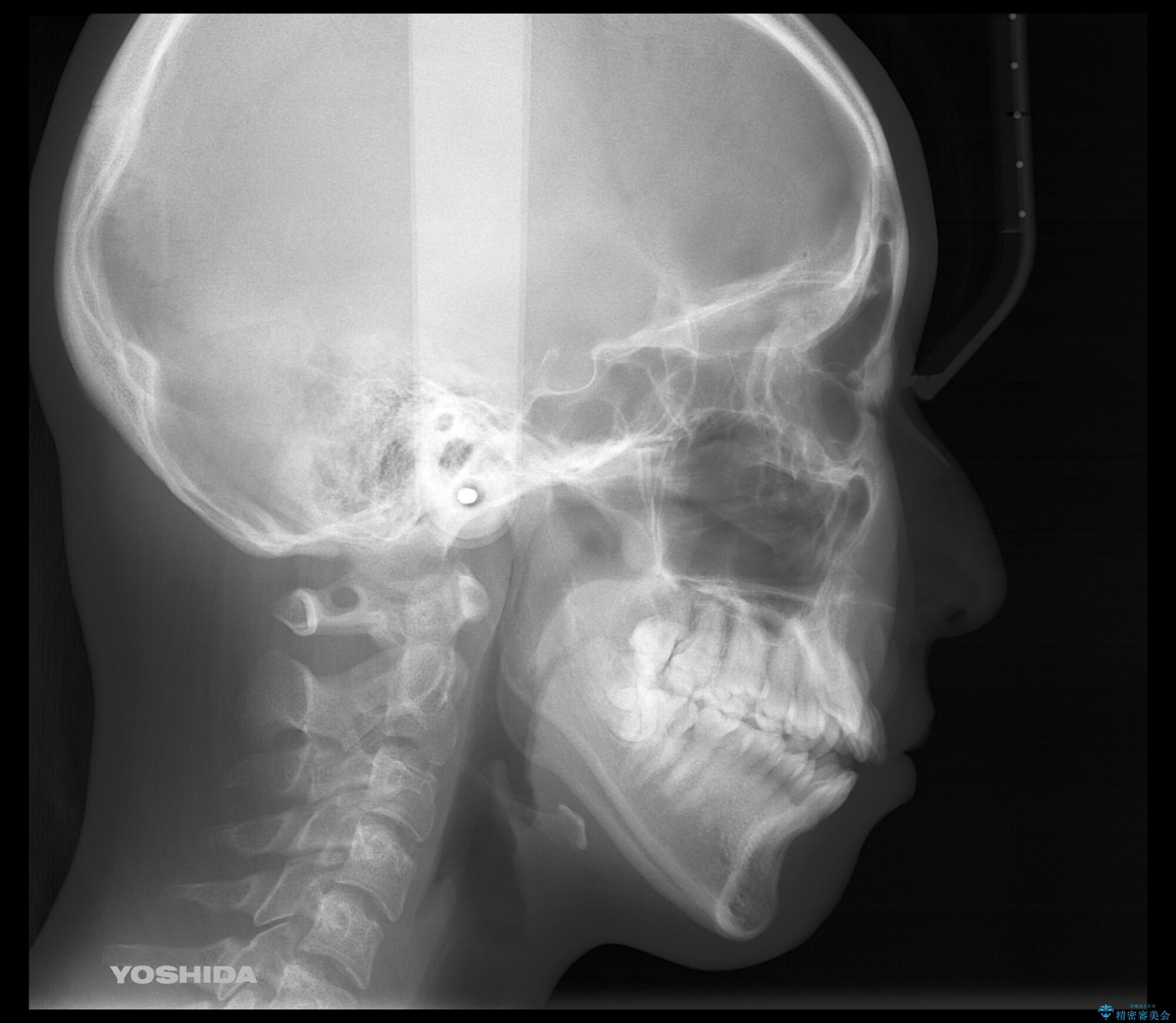 本来は外科ケース:インビザラインで前歯の重度がたつきとオープンバイトの改善の治療前(顔貌)