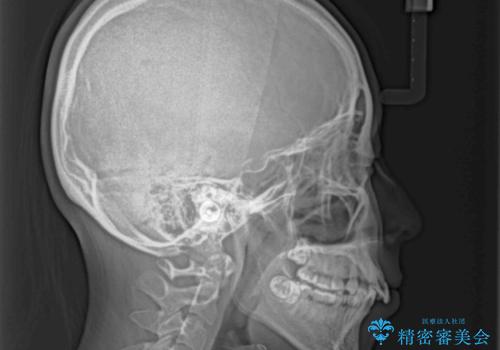 叢生・ディープバイト・突出 ワイヤー装置での抜歯矯正で全てを解決の治療前