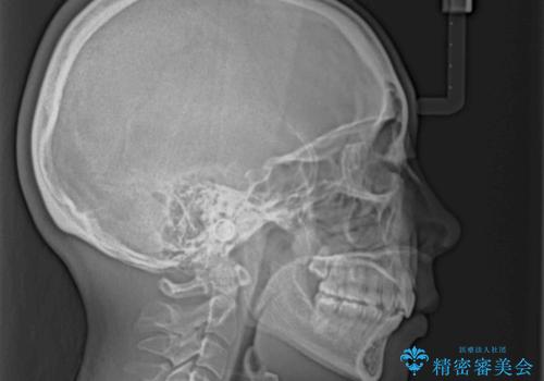 上顎前突で口が閉じにくい ワイヤー装置での抜歯矯正の治療後