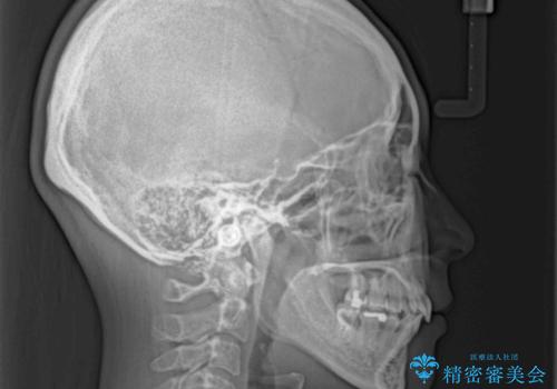出っ歯を治したい ワイヤー装置での抜歯矯正で劇的変化!の治療後