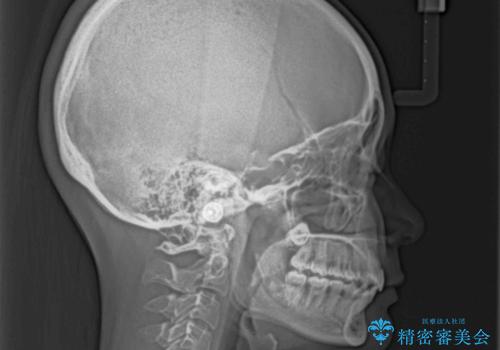 前に飛び出した上顎前歯をスッキリと引っ込める ワイヤー装置での矯正治療の治療後