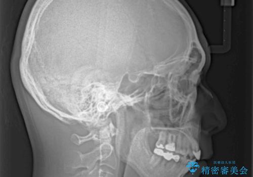 外科手術を検討? 過大な開咬をワイヤー装置とインビザラインで劇的に改善するの治療後