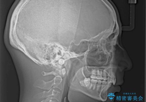 八重歯の抜歯矯正 インビザラインを用いて気になる歯並びを改善の治療後