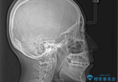 叢生・ディープバイト・突出 ワイヤー装置での抜歯矯正で全てを解決の治療後